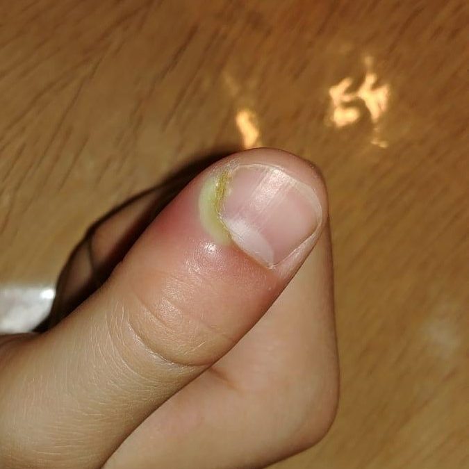 5 remèdes de grand-mère en cas de panari au doigt