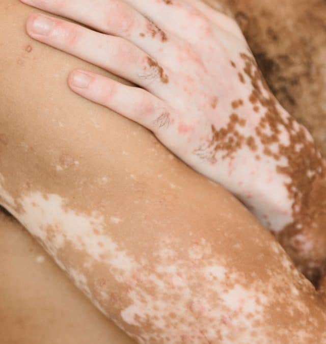 Y a-t-il un traitement naturel pour le vitiligo ?