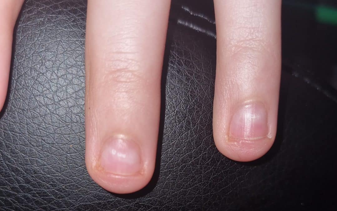 Taches blanches sur les ongles : calcium, zinc… ?